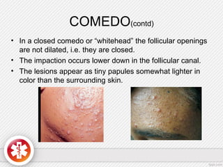 Secondary lesions & Special lesions in dermatology | PPT