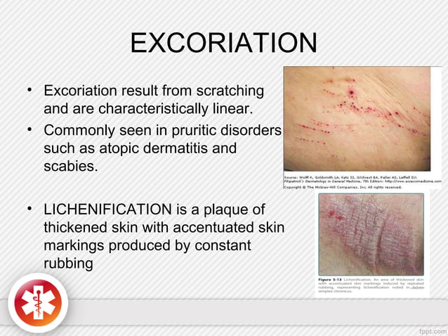 Secondary lesions & Special lesions in dermatology | PPT | Skin and ...
