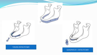 SANDWICH OSTEOTOMY
VISOR OSTEOTOMY
 