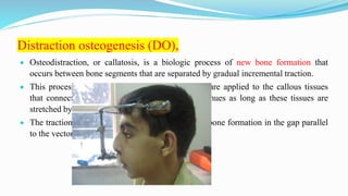 Distraction osteogenesis (DO),
 Osteodistraction, or callatosis, is a biologic process of new bone formation that
occurs between bone segments that are separated by gradual incremental traction.
 This process commences when distraction forces are applied to the callous tissues
that connect the divided bone segments and continues as long as these tissues are
stretched by the applied forces.
 The traction generates tension that stimulates new bone formation in the gap parallel
to the vector of distraction.
 