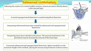 Following the creation of a vertical midline incision, scissors are used to bluntly dissect
a thin mucosal layer
A second supraperiosteal dissection is created using blunt dissection
, Interposing submucosal tissue layer created by submucosal and supraperiosteal
dissections
Interposing tissue layer is divided with scissors. The mucosal attachment to the
periosteum may be increased by removal of this tissue layer
Connected submucosal and supraperiosteal dissections. Splint extended in to the
maximum height of the vestibule, placing the mucosa and periosteum in direct contact
Submucosal vestibuloplasty
 