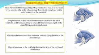 After elevation of the mucosal flap, the periosteum is incised at the crest
of the alveolar ridge and a subperiosteal dissection is completed on the
anterior aspect of the mandible
The periosteum is then sutured to the anterior aspect of the labial
vestibule, and the mucosal flap is sutured to the vestibular depth at the
area of the periosteal attachment.
Elevation of the mucosal flap, Periosteal incision along the crest of the
alveolar ridge.
Mucosa is sutured to the vestibular depth at the area of the periosteal
attachment
Transpositional flap vestibuloplasty
 