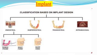 Implant
Implants can be classified into :
1. Endosteal implants , which are Ramus frame
Root form
Blade form
2.Supraperiosteal implants
3. Transosteal implants
4. Intramucosal implants
Based on attachment mechanism :
a. Osseointegration
b. Fibrointegration
 