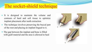 The socket-shield technique
 It is designed to maintain the volume and
contours of hard and soft tissue to optimize
implant placement after tooth extraction.
 The technique involves preserving the buccal part
of the root and placing an implant lingual to it.
 The gap between the implant and bone is filled
with graft material and the area is allowed to heal
 