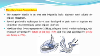  Maxillary Sinus Augmentation
 The posterior maxilla is an area that frequently lacks adequate bone volume for
implant placement.
 Several predictable techniques have been developed to graft bone to augment the
sinus floor to accommodate dental implant insertion.
 Maxillary sinus floor augmentation (MSFA), using the lateral window technique, was
originally developed by Tatum in the mid-1970s and was later described by Boyne
and James in 1980.
 