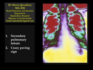 Dr MazenQusaibatyMD, DISHead Pulmonary and Internist Department Ibnalnafisse HospitalMinistry of Syrian healthEmail: Qusaibaty@gmail.com Secondary pulmonary lobule Crazy paving sign 