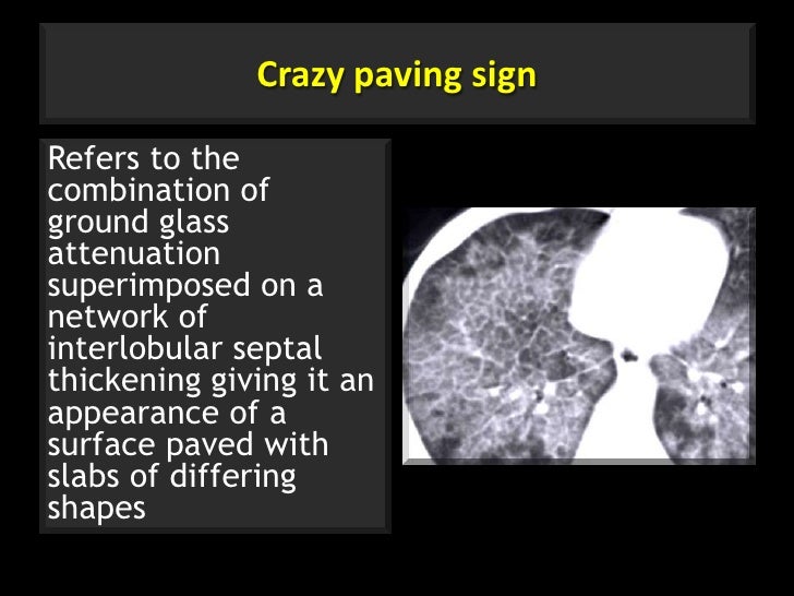 Secondary pulmonary lobule crazy paving sign