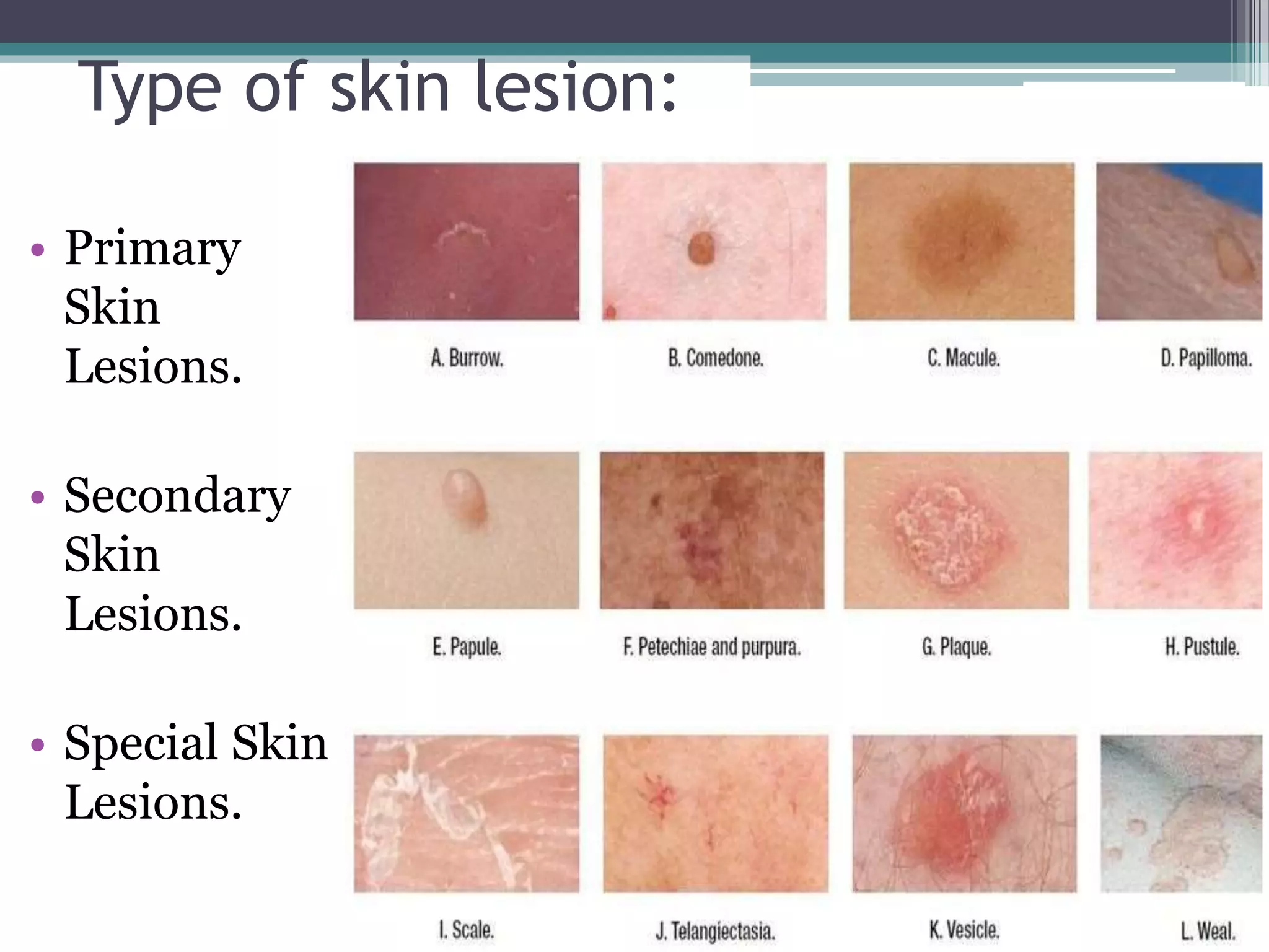 Secondary Skin Lesions PPTX Secondary Skin Lesions PPTX