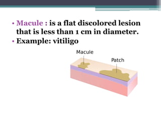 • Macule : is a flat discolored lesion
that is less than 1 cm in diameter.
• Example: vitiligo
 