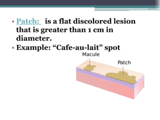 • Patch: is a flat discolored lesion
that is greater than 1 cm in
diameter.
• Example: “Cafe-au-lait” spot
 