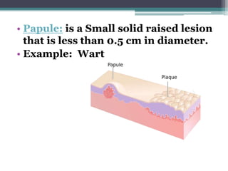 • Papule: is a Small solid raised lesion
that is less than 0.5 cm in diameter.
• Example: Wart
 