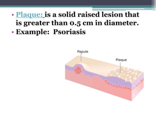 • Plaque: is a solid raised lesion that
is greater than 0.5 cm in diameter.
• Example: Psoriasis
 