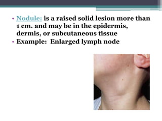 • Nodule: is a raised solid lesion more than
1 cm. and may be in the epidermis,
dermis, or subcutaneous tissue
• Example: Enlarged lymph node
 