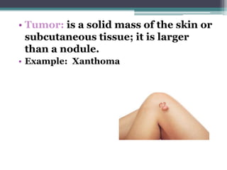 • Tumor: is a solid mass of the skin or
subcutaneous tissue; it is larger
than a nodule.
• Example: Xanthoma
 