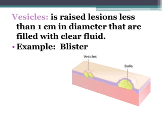 Vesicles: is raised lesions less
than 1 cm in diameter that are
filled with clear fluid.
• Example: Blister
 