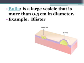 • Bulla: is a large vesicle that is
more than 0.5 cm in diameter.
• Example: Blister
 