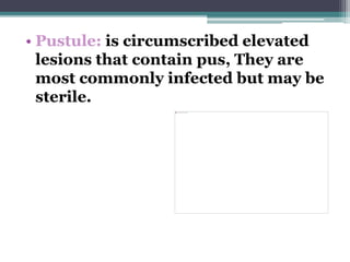 • Pustule: is circumscribed elevated
lesions that contain pus, They are
most commonly infected but may be
sterile.
 