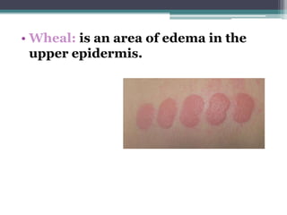 • Wheal: is an area of edema in the
upper epidermis.
 