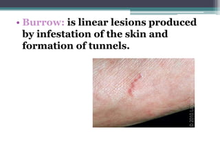• Burrow: is linear lesions produced
by infestation of the skin and
formation of tunnels.
 