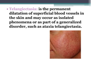 • Telangiectasia: is the permanent
dilatation of superficial blood vessels in
the skin and may occur as isolated
phenomena or as part of a generalized
disorder, such as ataxia telangiectasia.
 