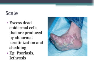 Scale
• Excess dead
epidermal cells
that are produced
by abnormal
keratinization and
shedding
• Eg: Psoriasis,
Icthyosis
 