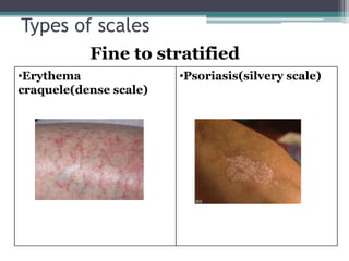 Types of scales
Fine to stratified
•Erythema
craquele(dense scale)
•Psoriasis(silvery scale)
 