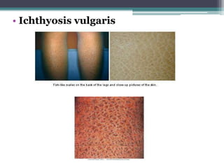 • Ichthyosis vulgaris
 