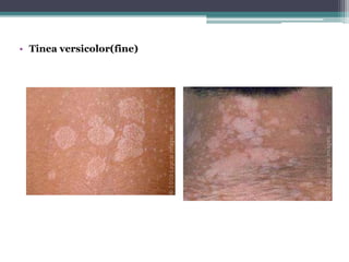 • Tinea versicolor(fine)
 