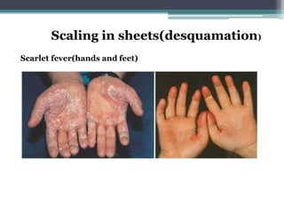 Scaling in sheets(desquamation)
Scarlet fever(hands and feet)
 