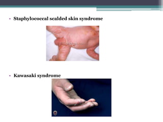 • Staphylococcal scalded skin syndrome
• Kawasaki syndrome
 