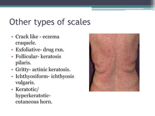 Other types of scales
• Crack like - eczema
craquele.
• Exfoliative- drug rxn.
• Follicular- keratosis
pilaris.
• Gritty- actinic keratosis.
• Ichthyosiform- ichthyosis
vulgaris.
• Keratotic/
hyperkeratotic-
cutaneous horn.
 
