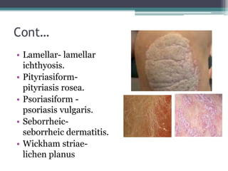 Cont…
• Lamellar- lamellar
ichthyosis.
• Pityriasiform-
pityriasis rosea.
• Psoriasiform -
psoriasis vulgaris.
• Seborrheic-
seborrheic dermatitis.
• Wickham striae-
lichen planus
 