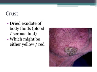 Crust
• Dried exudate of
body fluids (blood
/ serous fluid)
• Which might be
either yellow / red
 