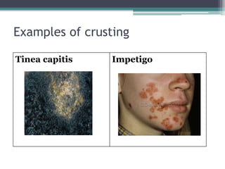 Examples of crusting
Tinea capitis Impetigo
 