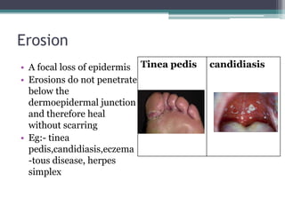 Erosion
• A focal loss of epidermis
• Erosions do not penetrate
below the
dermoepidermal junction
and therefore heal
without scarring
• Eg:- tinea
pedis,candidiasis,eczema
-tous disease, herpes
simplex
Tinea pedis candidiasis
 