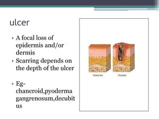 ulcer
• A focal loss of
epidermis and/or
dermis
• Scarring depends on
the depth of the ulcer
• Eg-
chancroid,pyoderma
gangrenosum,decubit
us
 