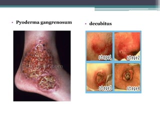 • Pyoderma gangrenosum • decubitus
 