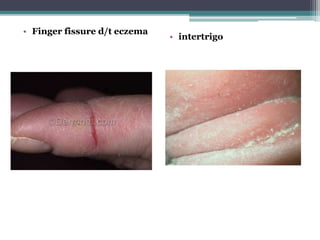 • Finger fissure d/t eczema
• intertrigo
 