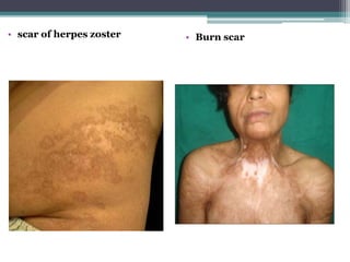 • scar of herpes zoster • Burn scar
 