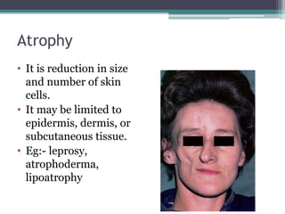 Atrophy
• It is reduction in size
and number of skin
cells.
• It may be limited to
epidermis, dermis, or
subcutaneous tissue.
• Eg:- leprosy,
atrophoderma,
lipoatrophy
 