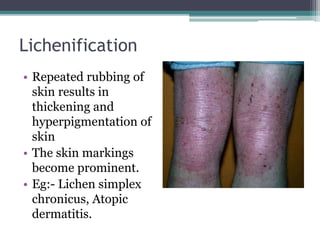 Lichenification
• Repeated rubbing of
skin results in
thickening and
hyperpigmentation of
skin
• The skin markings
become prominent.
• Eg:- Lichen simplex
chronicus, Atopic
dermatitis.
 