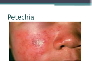 Petechia
 