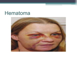 Hematoma
 