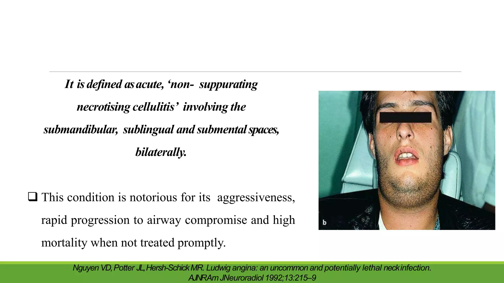 It isdefined asacute, ‘non- suppurating
necrotising cellulitis’ involving the
submandibular, sublingual and submentalspaces,
bilaterally.
 This condition is notorious for its aggressiveness,
rapid progression to airway compromise and high
mortality when not treated promptly.
Nguyen VD,Potter JL,Hersh-SchickMR. Ludwig angina: an uncommon and potentially lethal neckinfection.
AJNRAmJNeuroradiol 1992;13:215–9
 