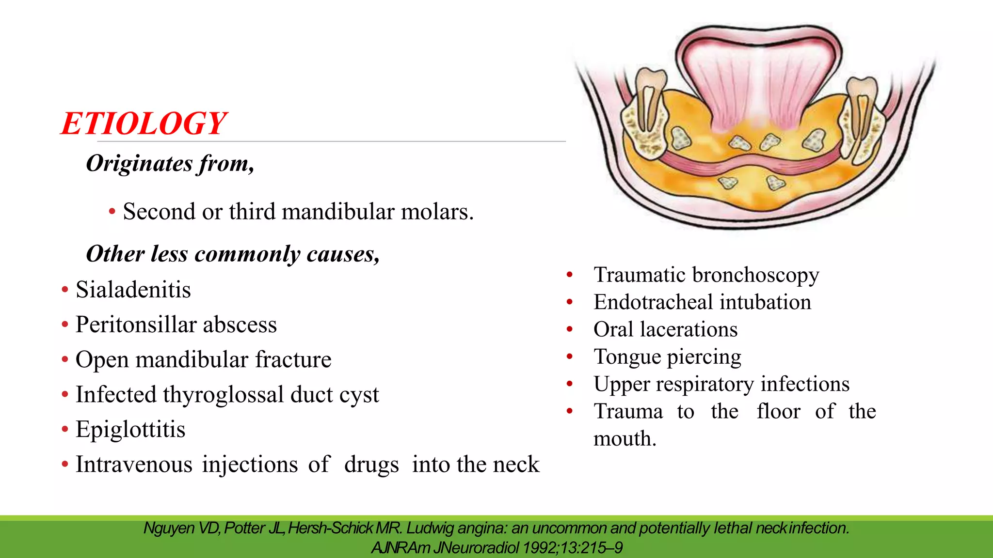 ETIOLOGY
Originates from,
• Second or third mandibular molars.
Other less commonly causes,
• Sialadenitis
• Peritonsillar abscess
• Open mandibular fracture
• Infected thyroglossal duct cyst
• Epiglottitis
• Intravenous injections of drugs into the neck
• Traumatic bronchoscopy
• Endotracheal intubation
• Oral lacerations
• Tongue piercing
• Upper respiratory infections
• Trauma to the floor of the
mouth.
Nguyen VD,Potter JL,Hersh-SchickMR. Ludwig angina: an uncommon and potentially lethal neckinfection.
AJNRAmJNeuroradiol 1992;13:215–9
 