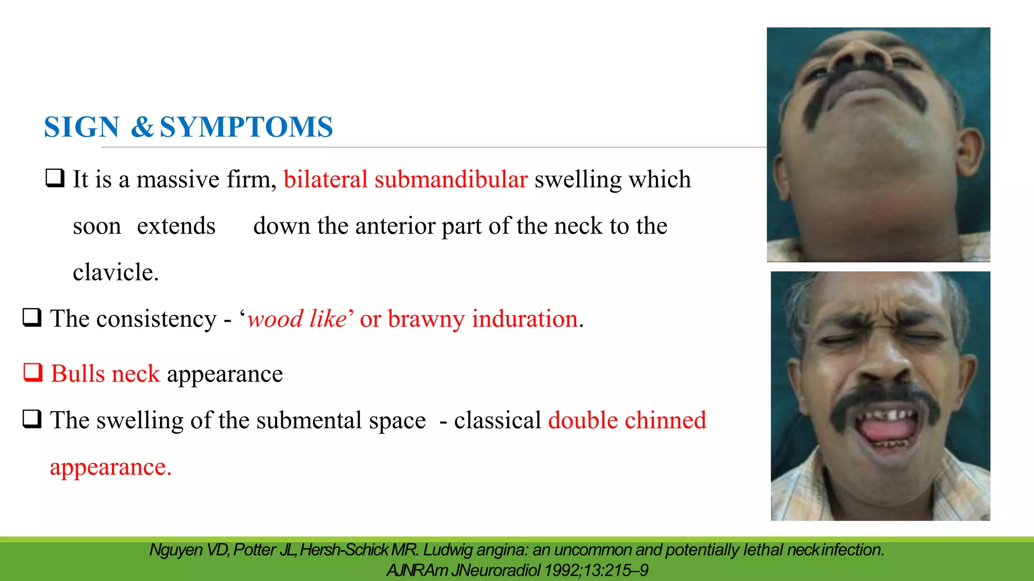 SIGN &SYMPTOMS
 It is a massive firm, bilateral submandibular swelling which
soon extends down the anterior part of the neck to the
clavicle.
 The consistency - ‘wood like’ or brawny induration.
 Bulls neck appearance
 The swelling of the submental space - classical double chinned
appearance.
Nguyen VD,Potter JL,Hersh-SchickMR. Ludwig angina: an uncommon and potentially lethal neckinfection.
AJNRAmJNeuroradiol 1992;13:215–9
 
