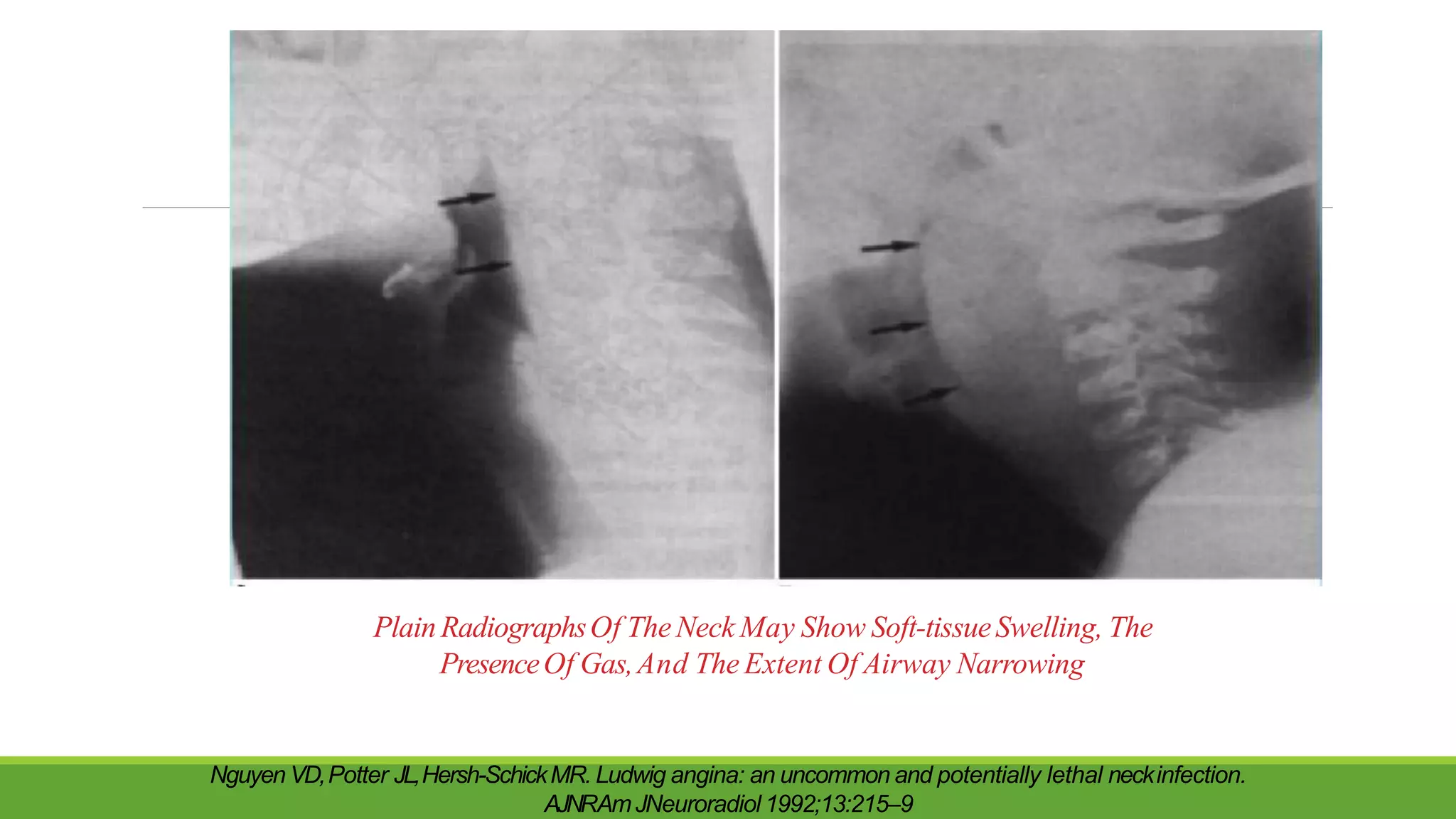 PlainRadiographsOf TheNeck May Show Soft-tissueSwelling, The
PresenceOf Gas,And The Extent Of Airway Narrowing
Nguyen VD,Potter JL,Hersh-SchickMR. Ludwig angina: an uncommon and potentially lethal neckinfection.
AJNRAmJNeuroradiol 1992;13:215–9
 
