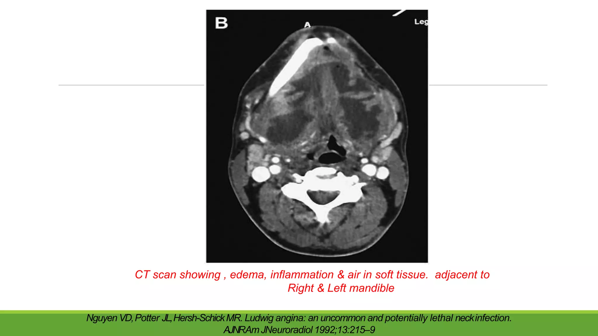CT scan showing , edema, inflammation & air in soft tissue. adjacent to
Right & Left mandible
Nguyen VD,Potter JL,Hersh-SchickMR. Ludwig angina: an uncommon and potentially lethal neckinfection.
AJNRAmJNeuroradiol 1992;13:215–9
 