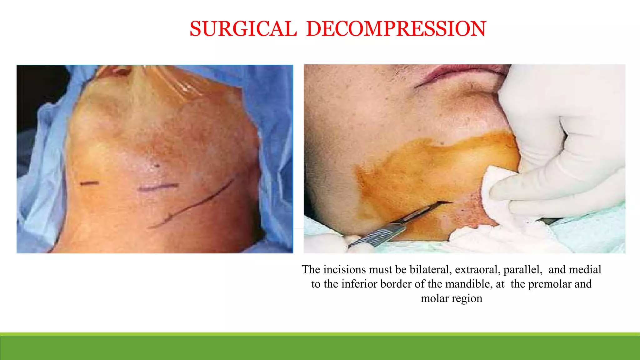 SURGICAL DECOMPRESSION
The incisions must be bilateral, extraoral, parallel, and medial
to the inferior border of the mandible, at the premolar and
molar region
 