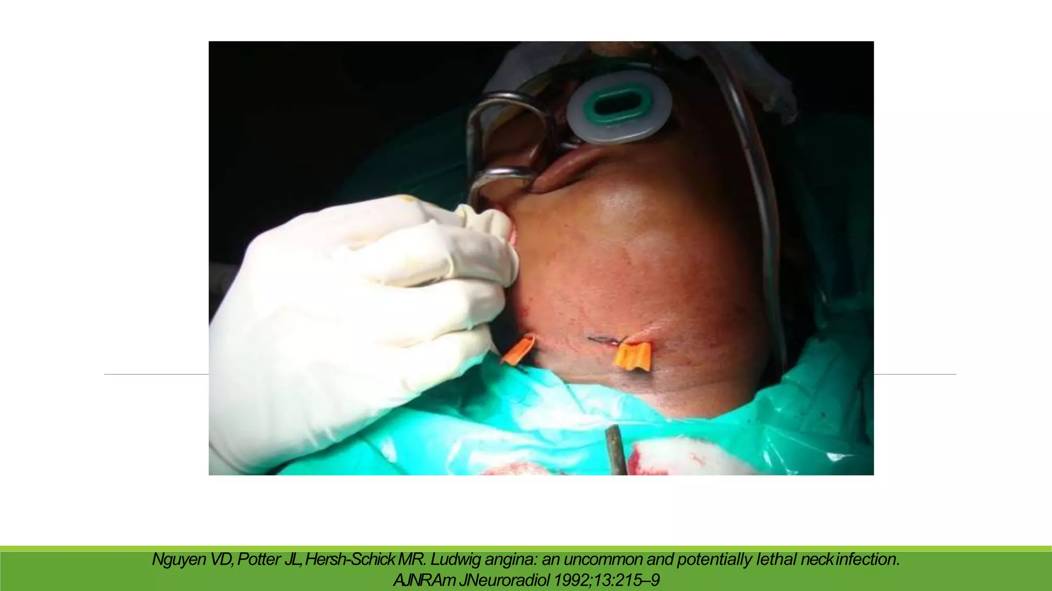 Nguyen VD,Potter JL,Hersh-SchickMR. Ludwig angina: an uncommon and potentially lethal neckinfection.
AJNRAmJNeuroradiol 1992;13:215–9
 
